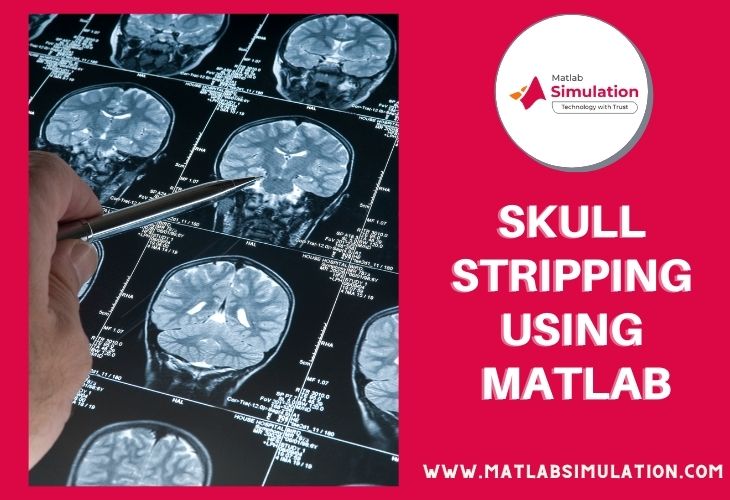 Implementing Skull Stripping Using Matlab